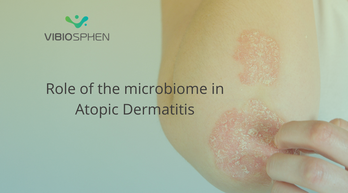 Atopic Dermatitis